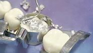 FDA Hearing on Mercury-Based Fillings Will Question Safety Threshold