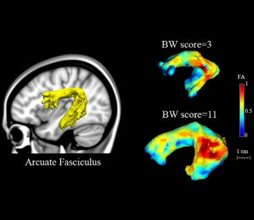 Brain Scans Could Detect Dyslexia