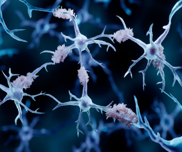 Alzheimer's drug donanemab deemed effective in landmark clinical trial