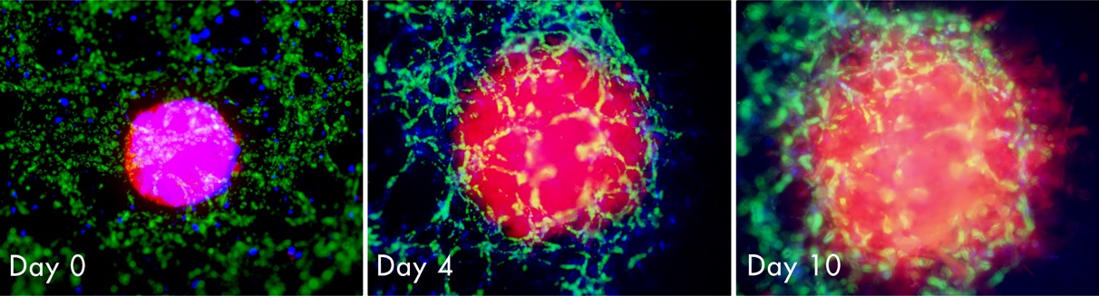 3D Model Evaluates Cancer Progress