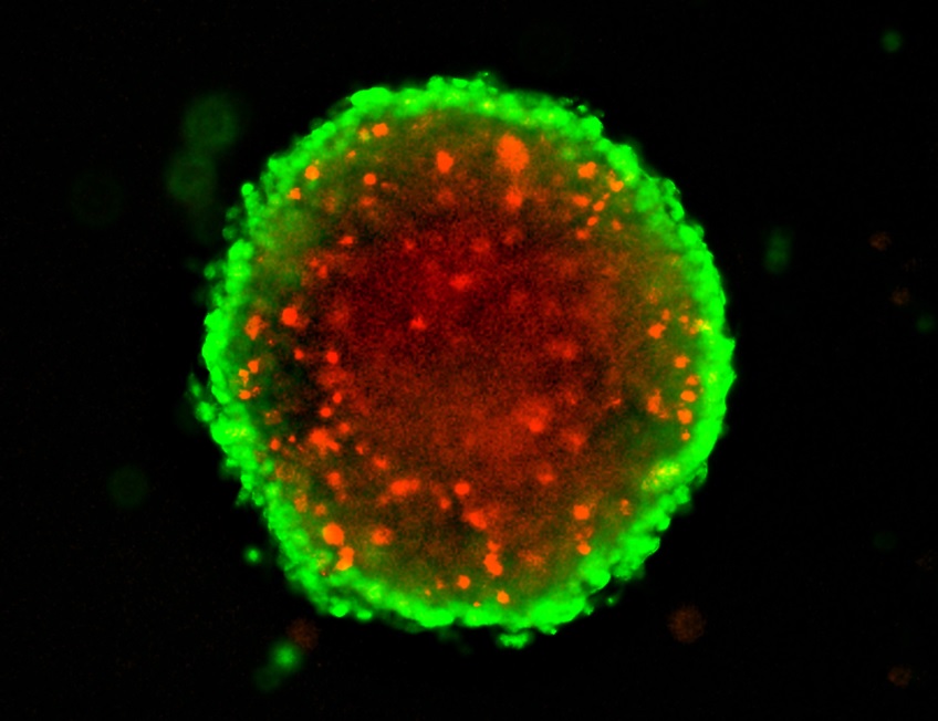 3D Spheroid Assays for Cancer Drug Screening
