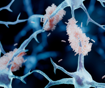 Alzheimer's drug lecanemab shows reduced cognitive decline in clinical trial