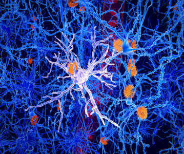Alzheimer's drug Leqembi receives go ahead from the FDA to be used in patients