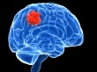 Brain tumour investment 'lagging'