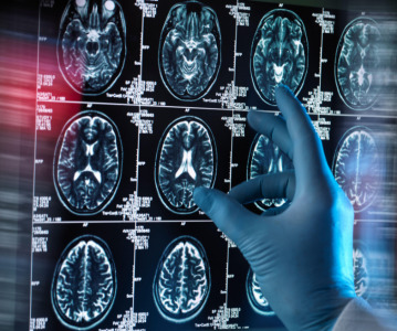 Eli Lilly's Alzheimer's drug falls short for accelerated approval from the FDA