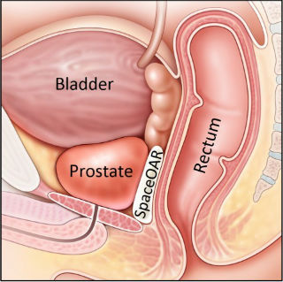 First prostate cancer patients treated with Augmenix's SpaceOAR Hydrogel in Israel