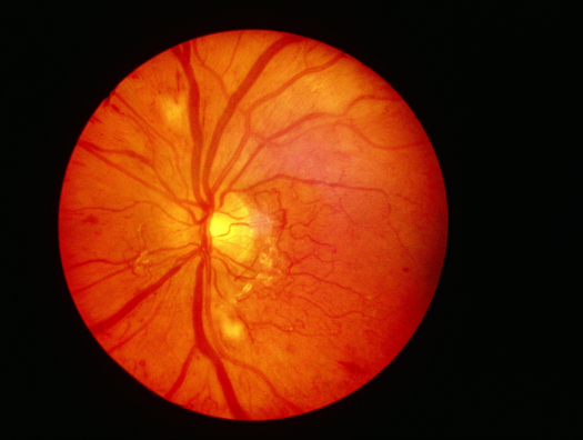 Ophthalmologic drug product Eylea faces biosimilar threats after FDA approvals