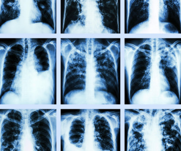 Sanofi gains rare disease therapy in acquisition of Inhibrx for US$1.7 billion