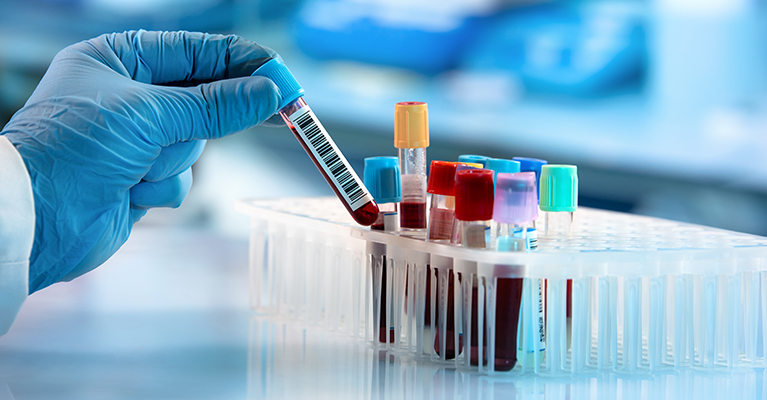 Study demonstrates potential of blood test for early lung cancer detection